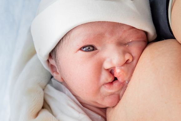 Nascimento Emanuel - Cesarea